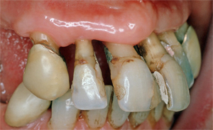 Fig. 1: Alvorlig periodontitt.