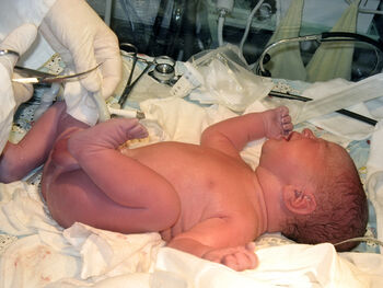 Bildet viser en nyfødt baby som ligger på ryggen og to hanske-kledte hender behandler babyen.