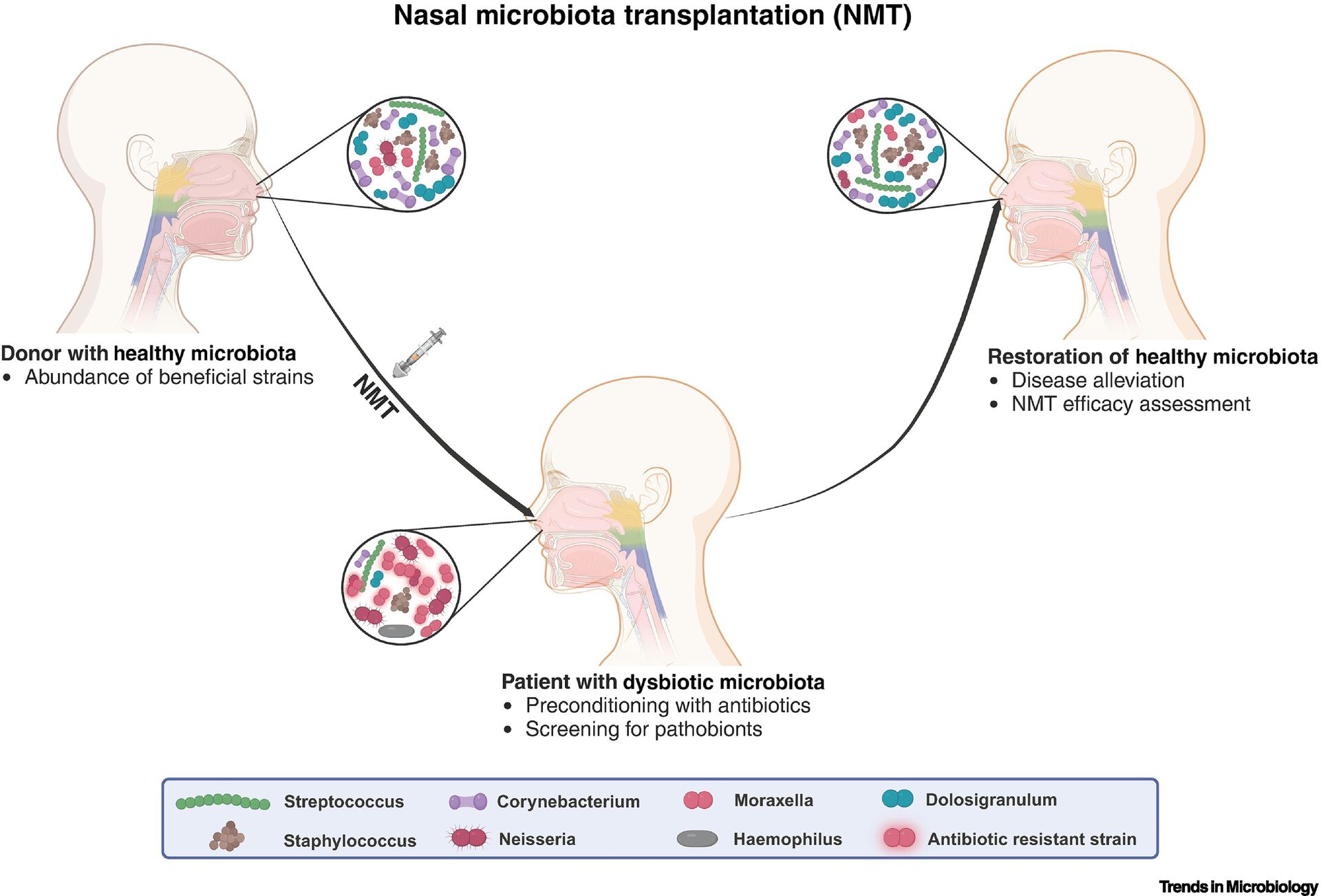 Illustration of nasal transplantation