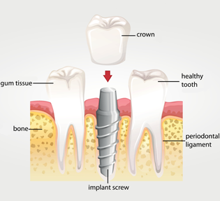 tegnet illustrasjon av et implantat i en munn, skruen er festet i det lysegule kjevebeinet, og en kunstig tann settes på toppen av skruen.