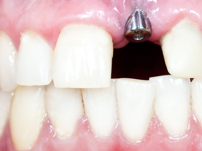 Teeth inside a mouth, where one of the front teeth is substituted with an empty room and an implant is visible in the gum