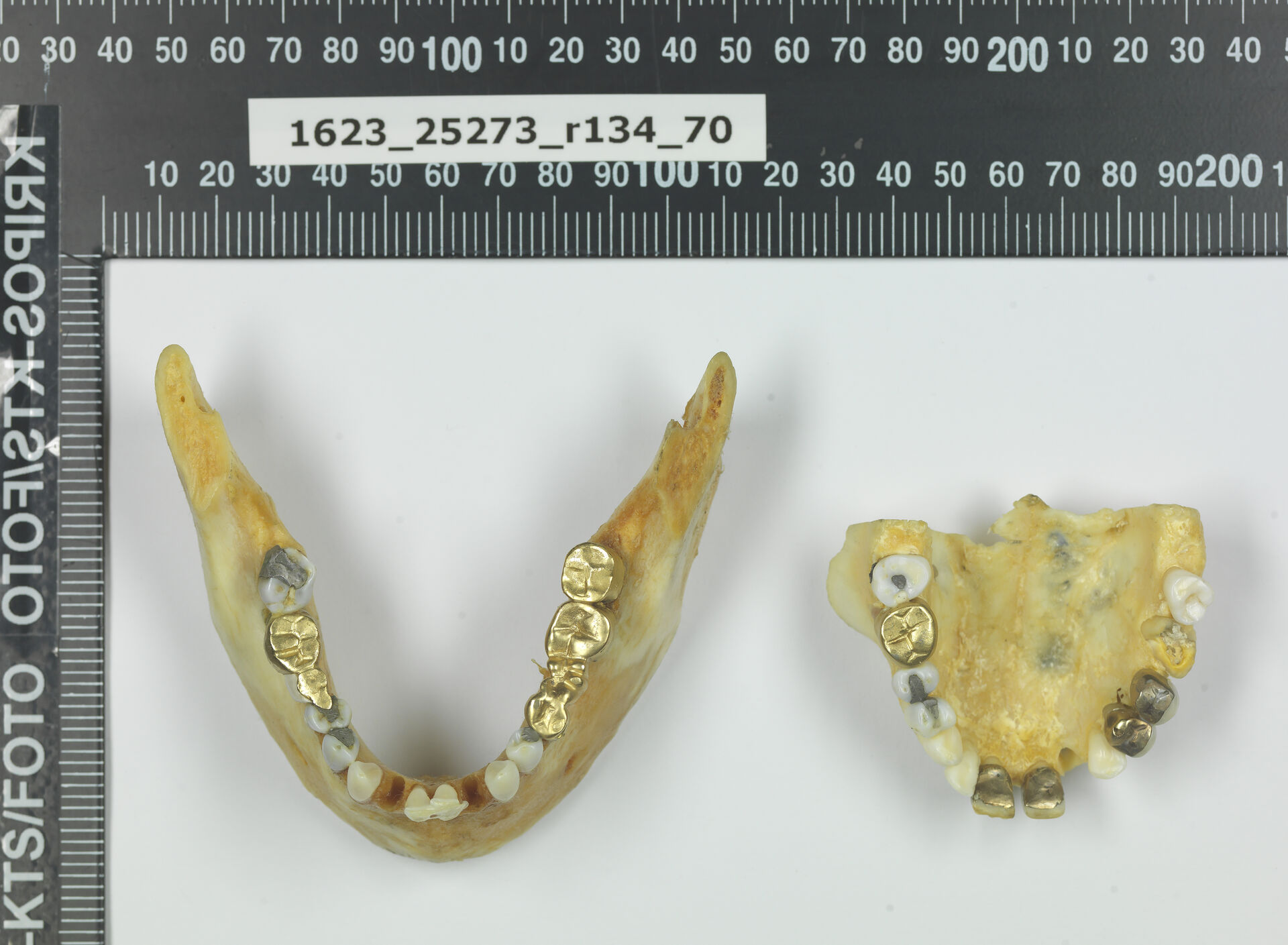 Det var gjort en god del arbeid på tannsettet til «Isdalskvinnen», blant annet en rekke gullbroer som ikke var typisk for norsk tannbehandling.
