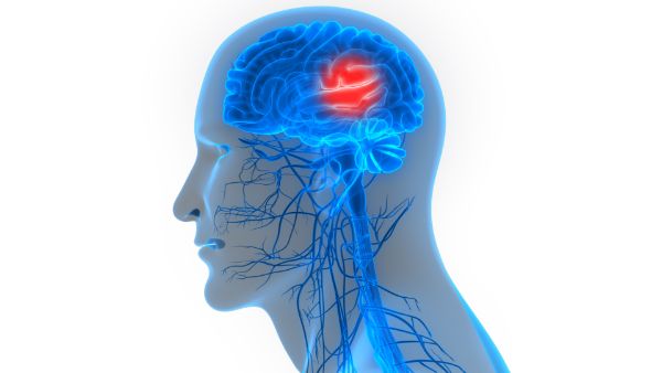 Man, Headache, Red area in the brain