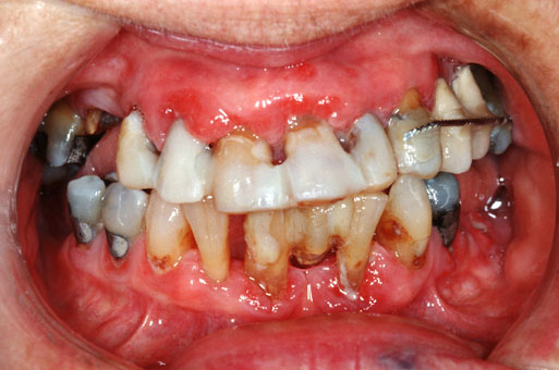 Fig. 1. Pasient med uttalt marginal periodontitt (Foto: Morten Enersen, UiO)