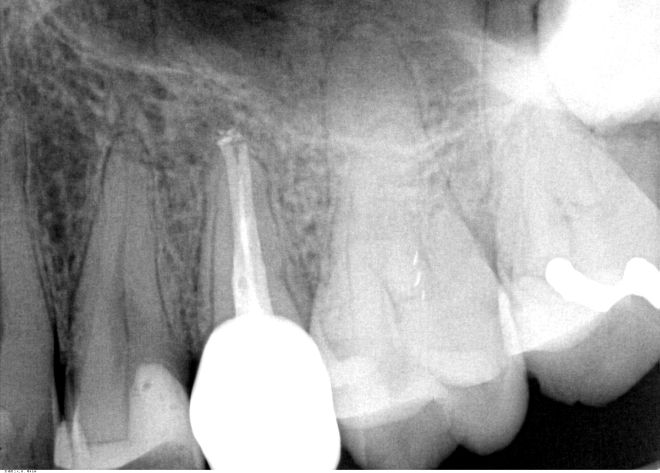 Røntgenbilde av rotfylt tann