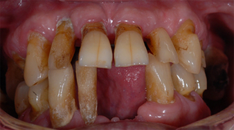 Dårlig munnhygiene. Tenner. uttalt peridontitt med store ansamlinger av tannbelegg på gjenstående tenner. Periodontitt med tannbelegg.