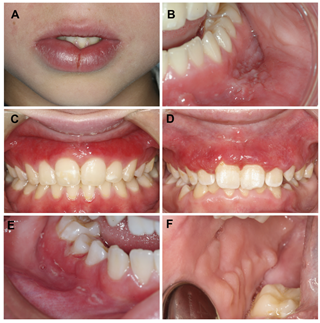 Oral disease and its effect on teeth and jaw