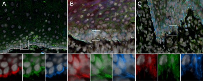 Farging for tre komponenter av hemidesmosomer i oral lichen planus