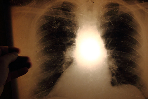 Røntgenbilde av bryst og lunger, illustrasjonsfoto.
