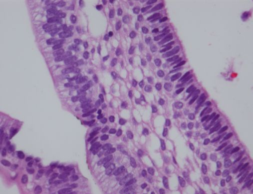Ameloblastom, mikroskopisk bilde av tumor i tanndannende vev
