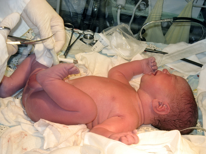 Bildet viser en nyfødt baby som ligger på ryggen og to hanske-kledte hender behandler babyen.